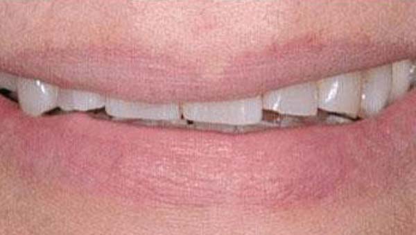 A smile before treatment, uneven and gapped