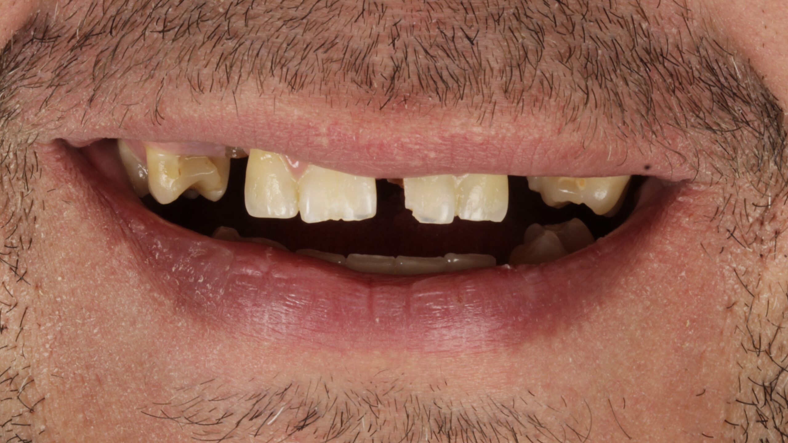 Before: double arch case 46
