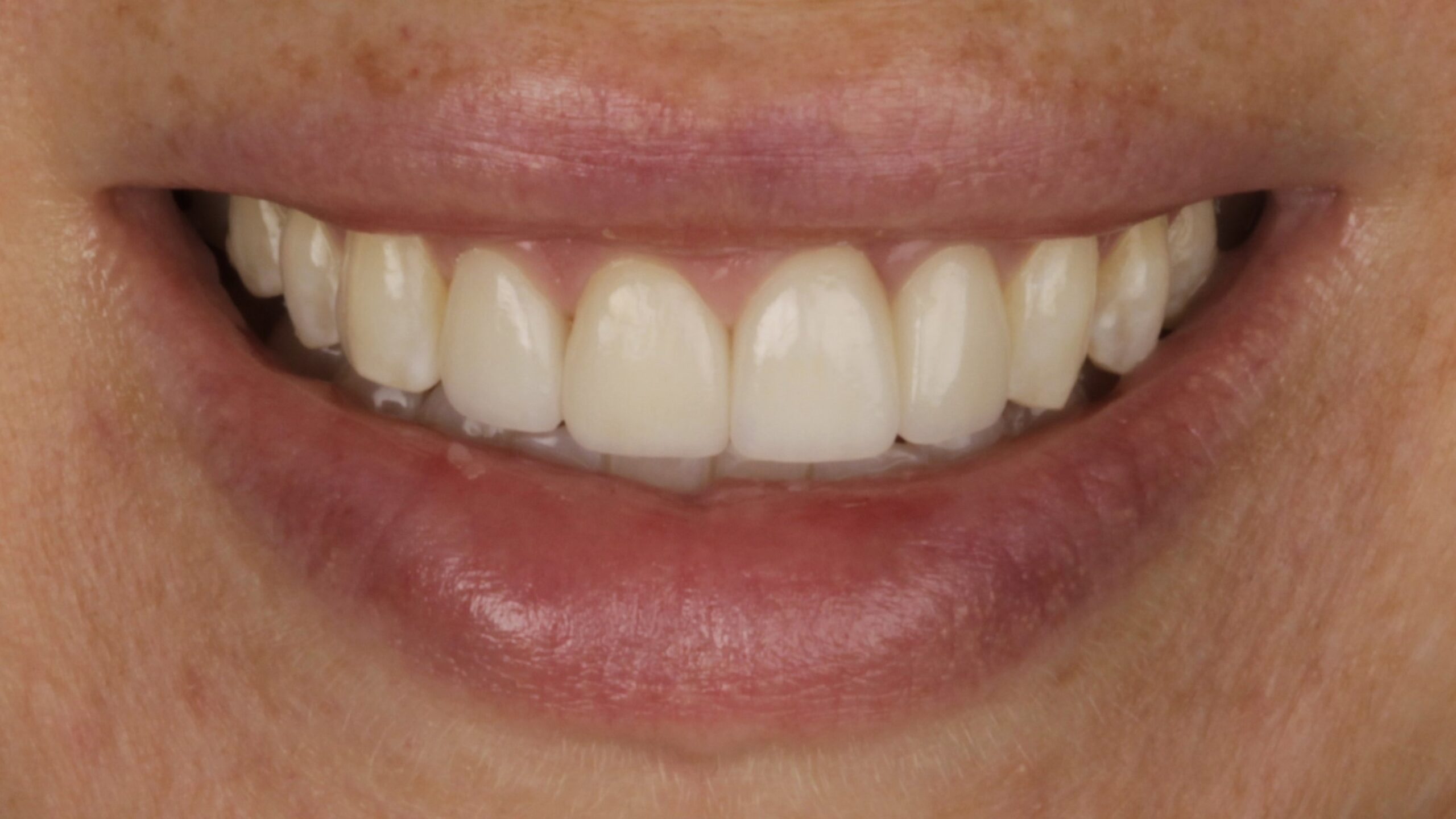 A finished porcelain veneer case