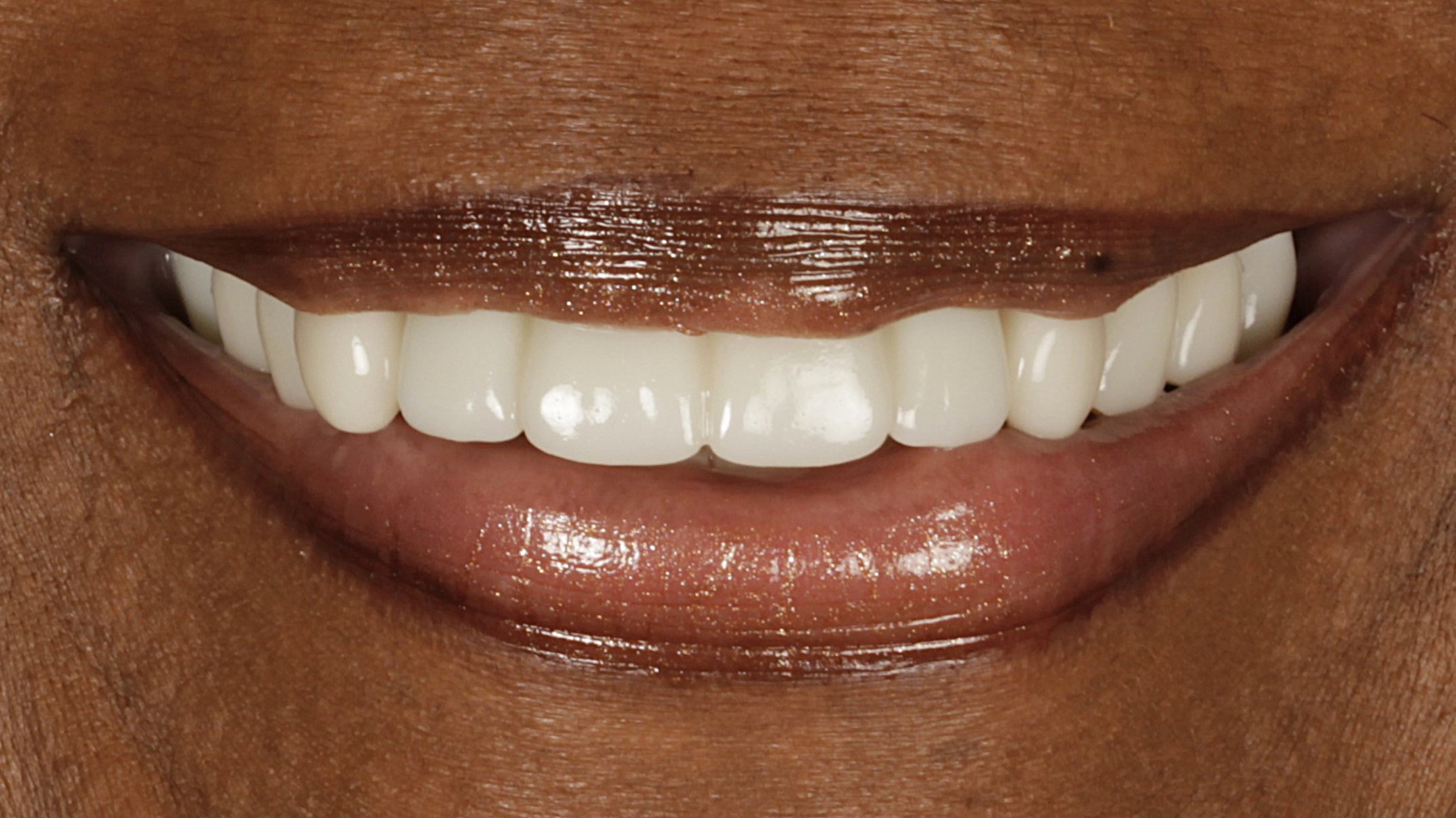 The same smile after treatment
