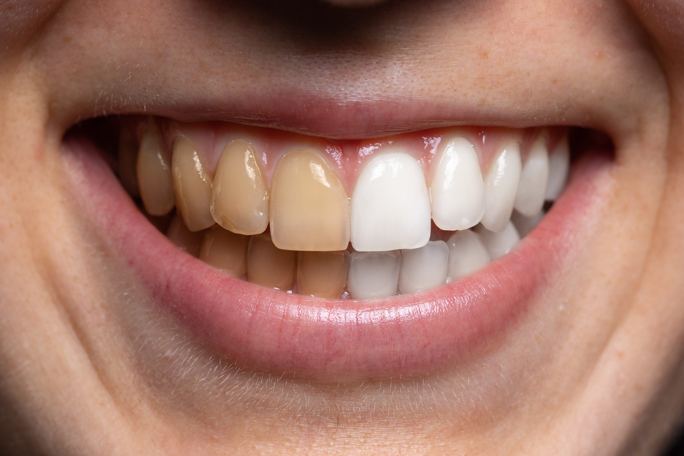 Close-up smile split down the middle: stained yellow teeth on one side, whitened teeth on the other