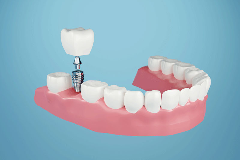 Illustration of a lower jaw with a single implant, abutment and crown positioned above a gap in the arch