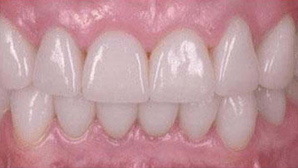 After: porcelain veneers case 17