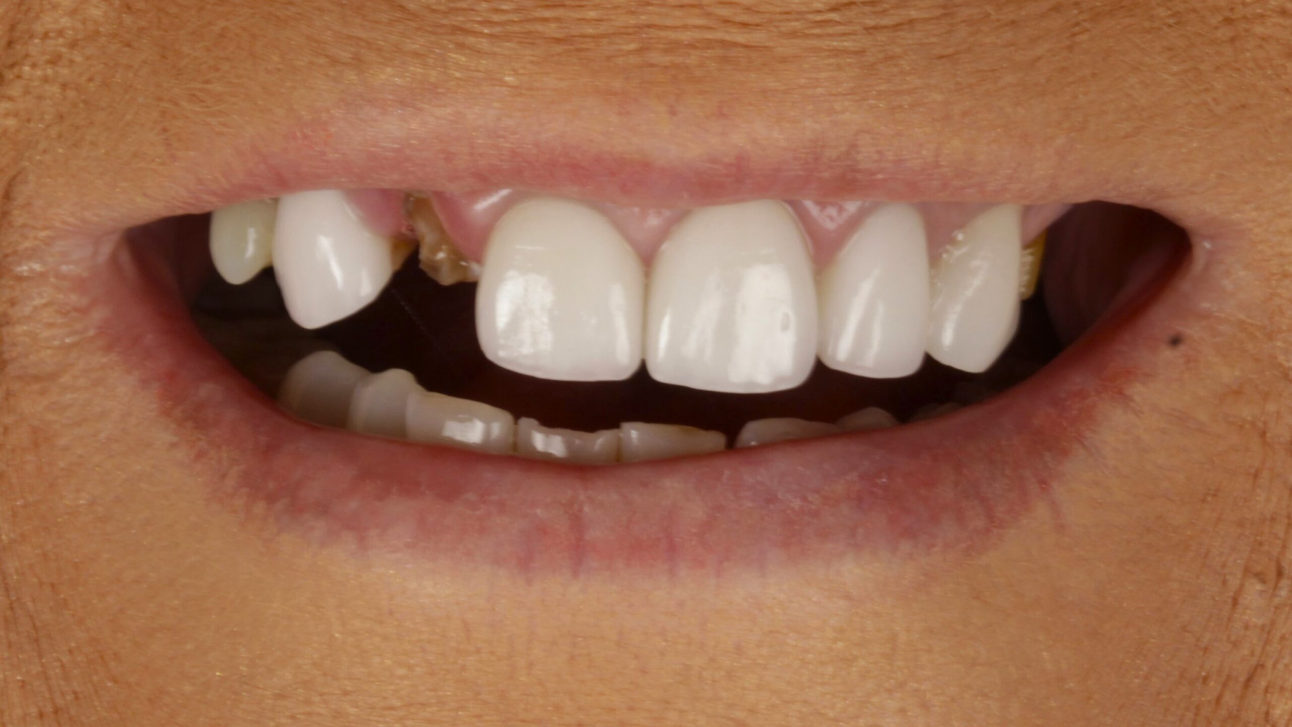 Before: double arch case 28