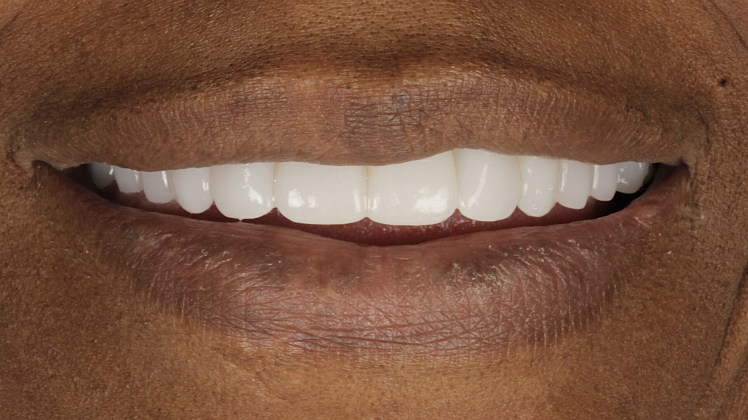 After: double arch case 23