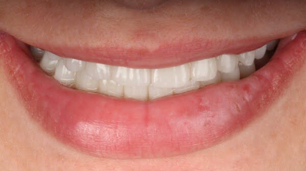 After: all-on-4 case 10