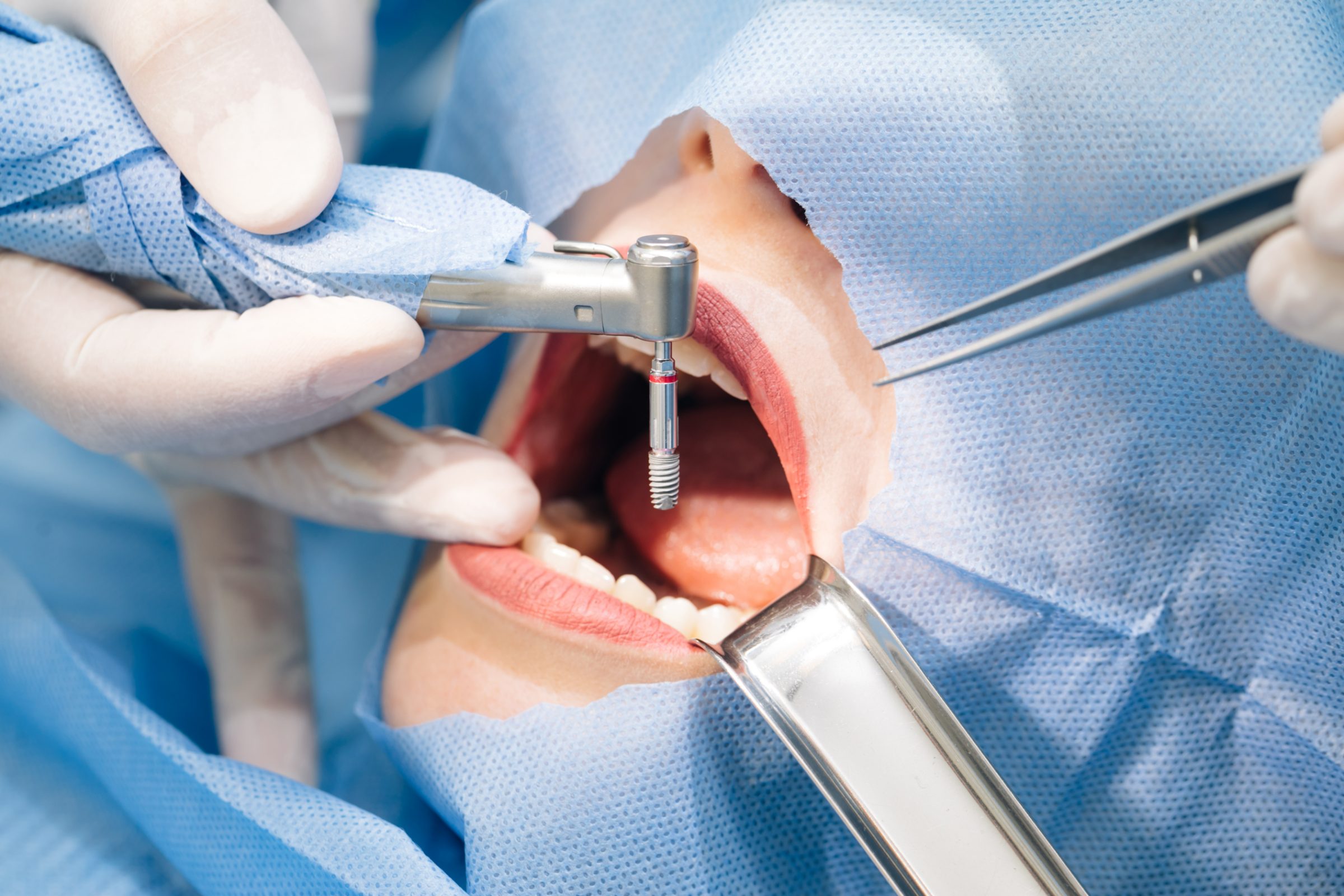 Close-up of dental implant surgery, with a handpiece placing an implant post in the patient's mouth
