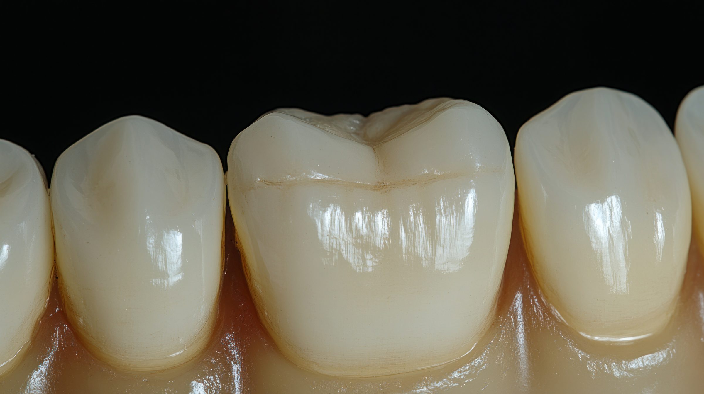 Macro view of a lower tooth restored with a tooth-colored ceramic onlay between natural teeth