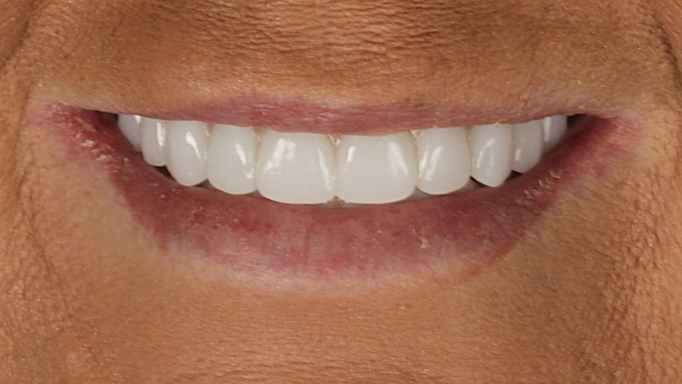 After: double arch case 28