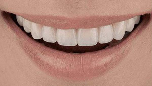 After: porcelain restoration