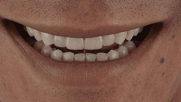 After: porcelain veneers case 14
