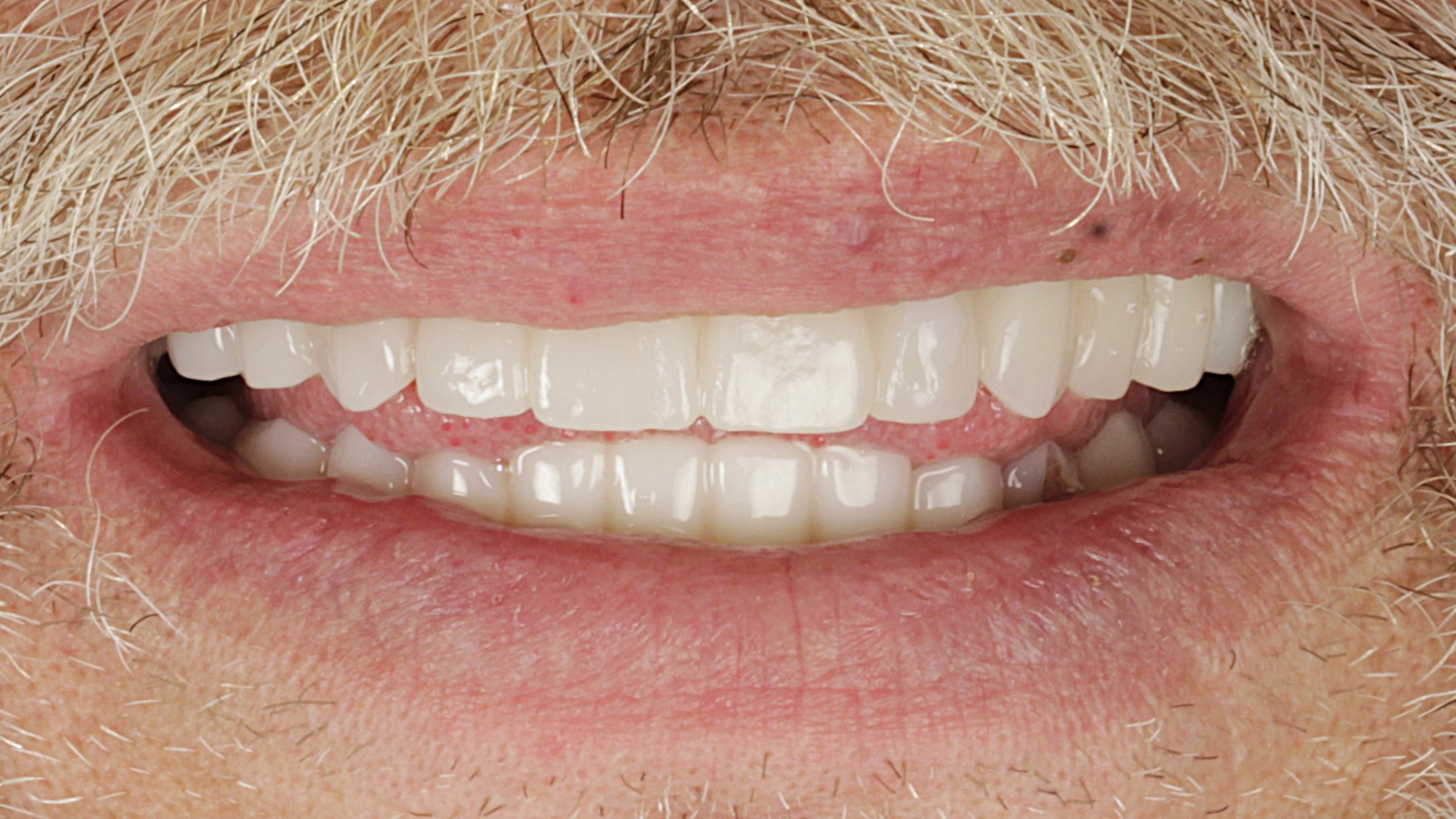 After: double arch case 25