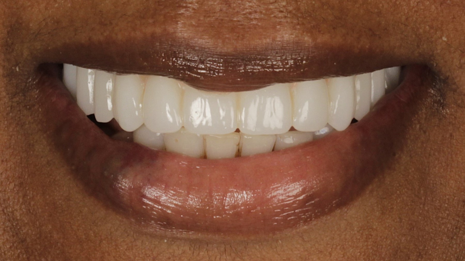 An upper arch restored on four implants