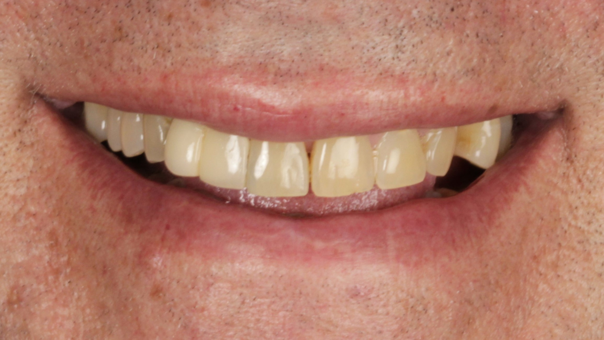 Before: veneers + implants case 42