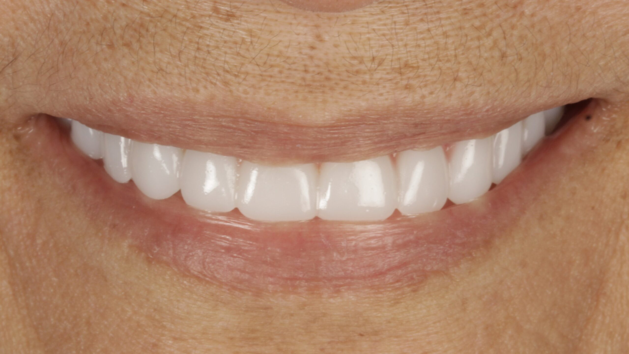 After: double arch case 33