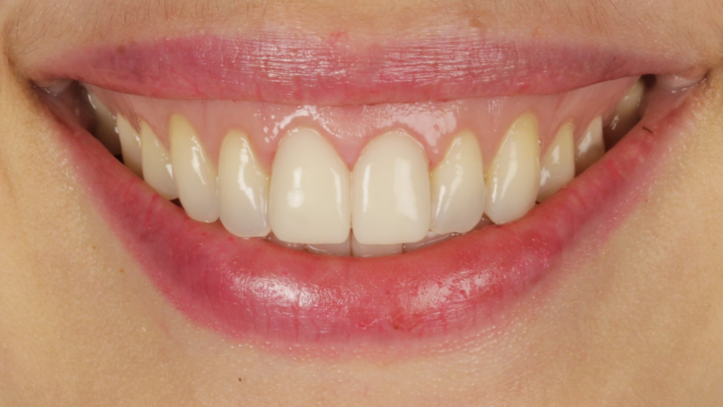 A completed porcelain veneer case