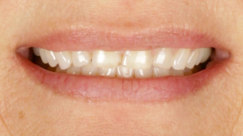 Before: porcelain veneers case 34