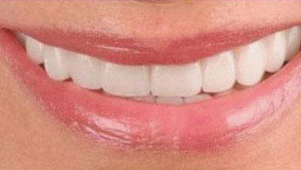 The same smile after a completed makeover