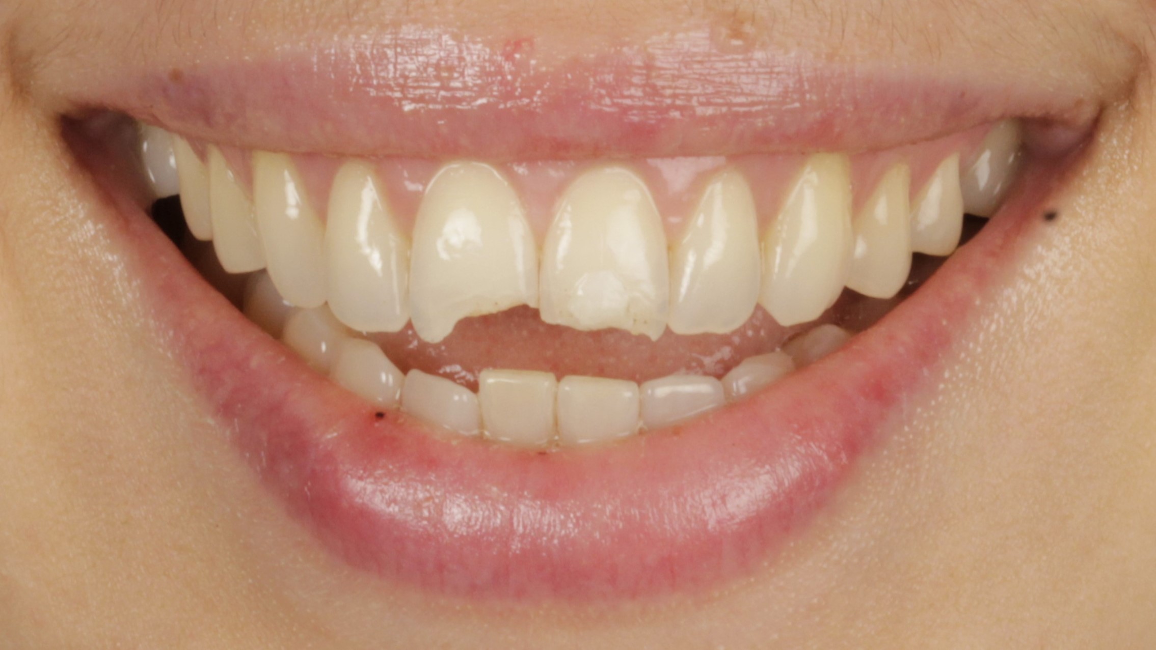 Before: porcelain veneers case 36
