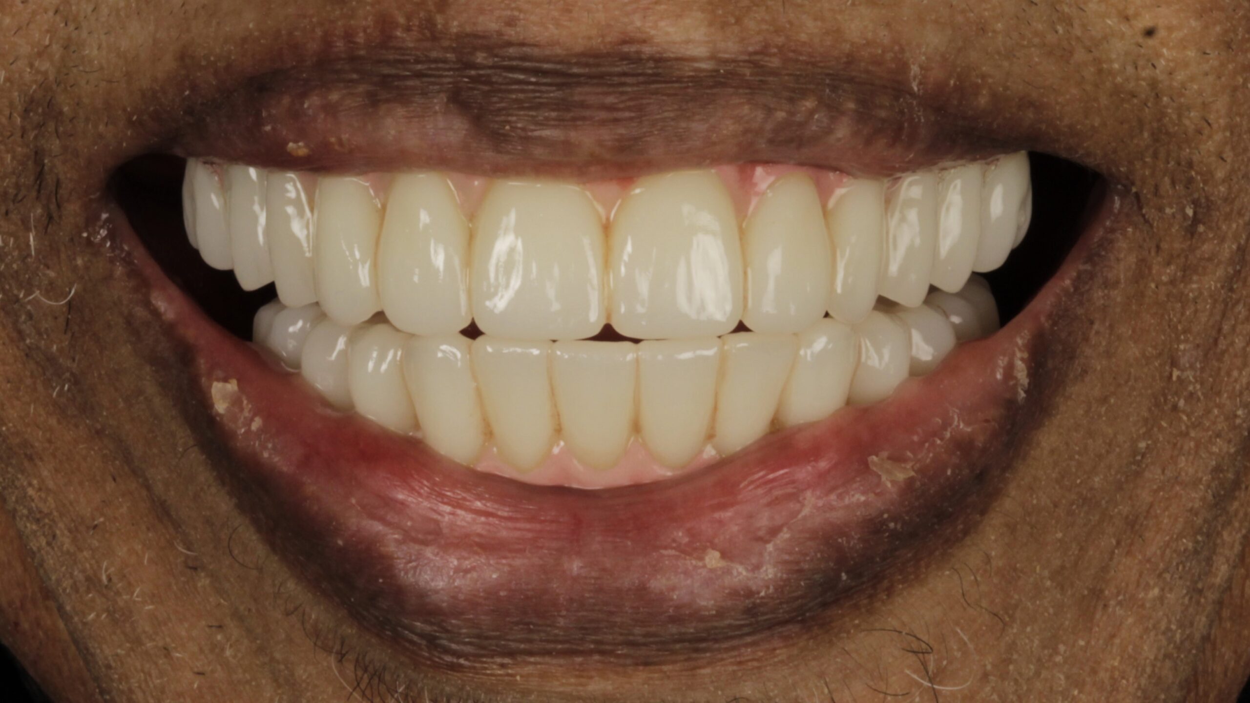 After: double arch case 31