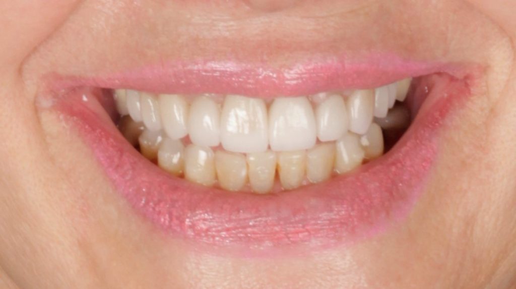 After: full mouth reconstruction case 4