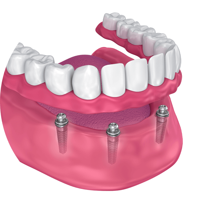 Illustration of a denture clipped onto three implants in the lower jaw