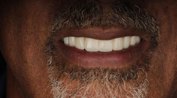 After: a fixed full arch on implants