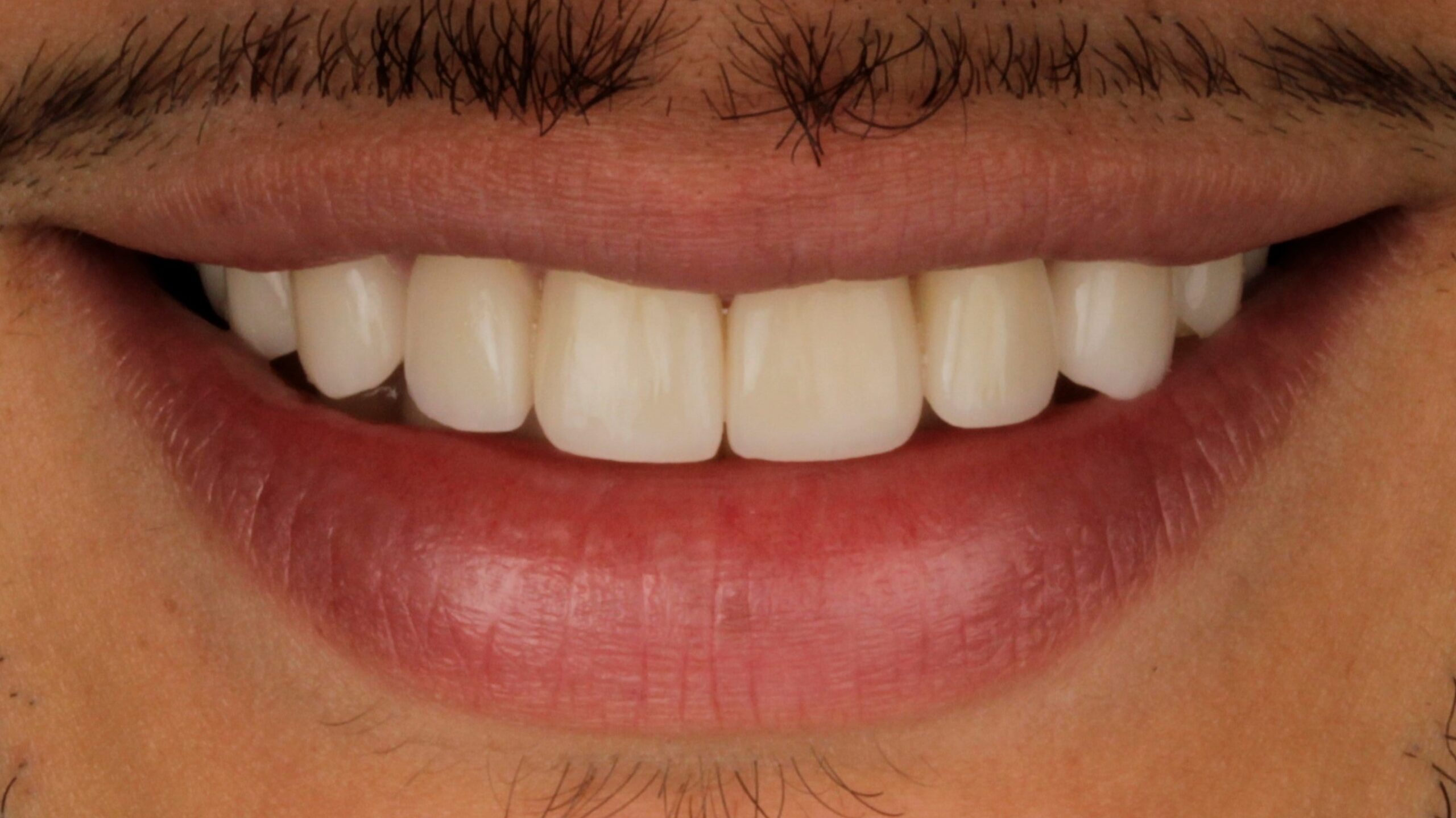 After: porcelain veneers case 35