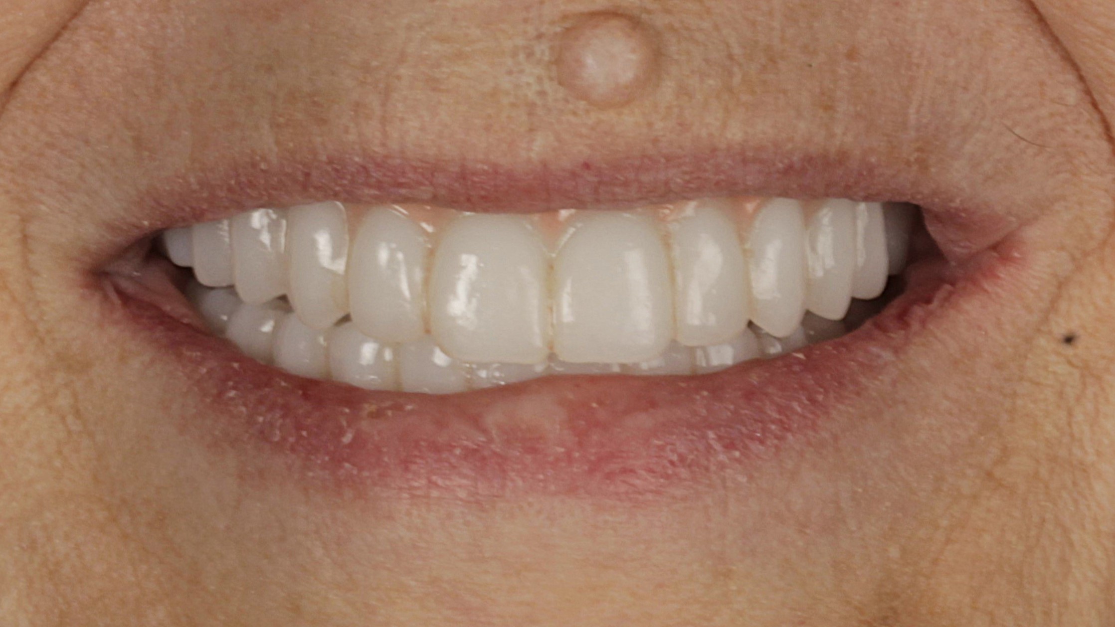 After: double arch case 29