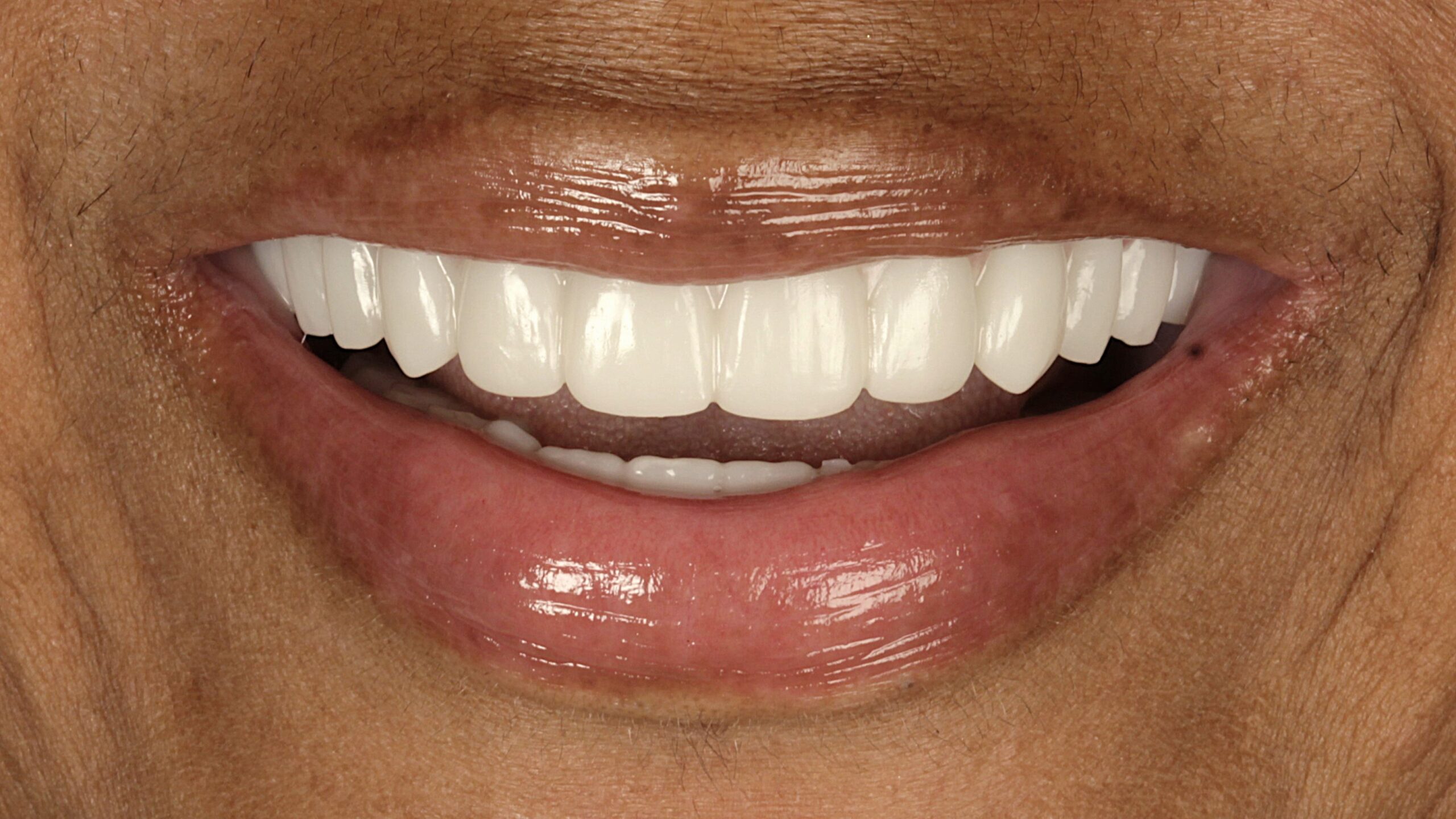 After: double arch case 22