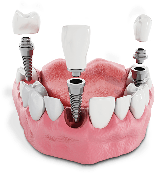 A multi-implant restoration model