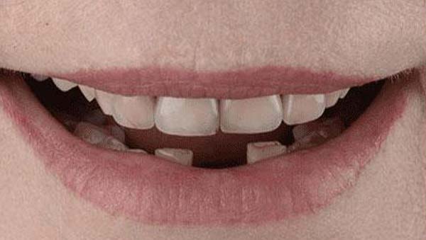 Before: porcelain veneers case 18