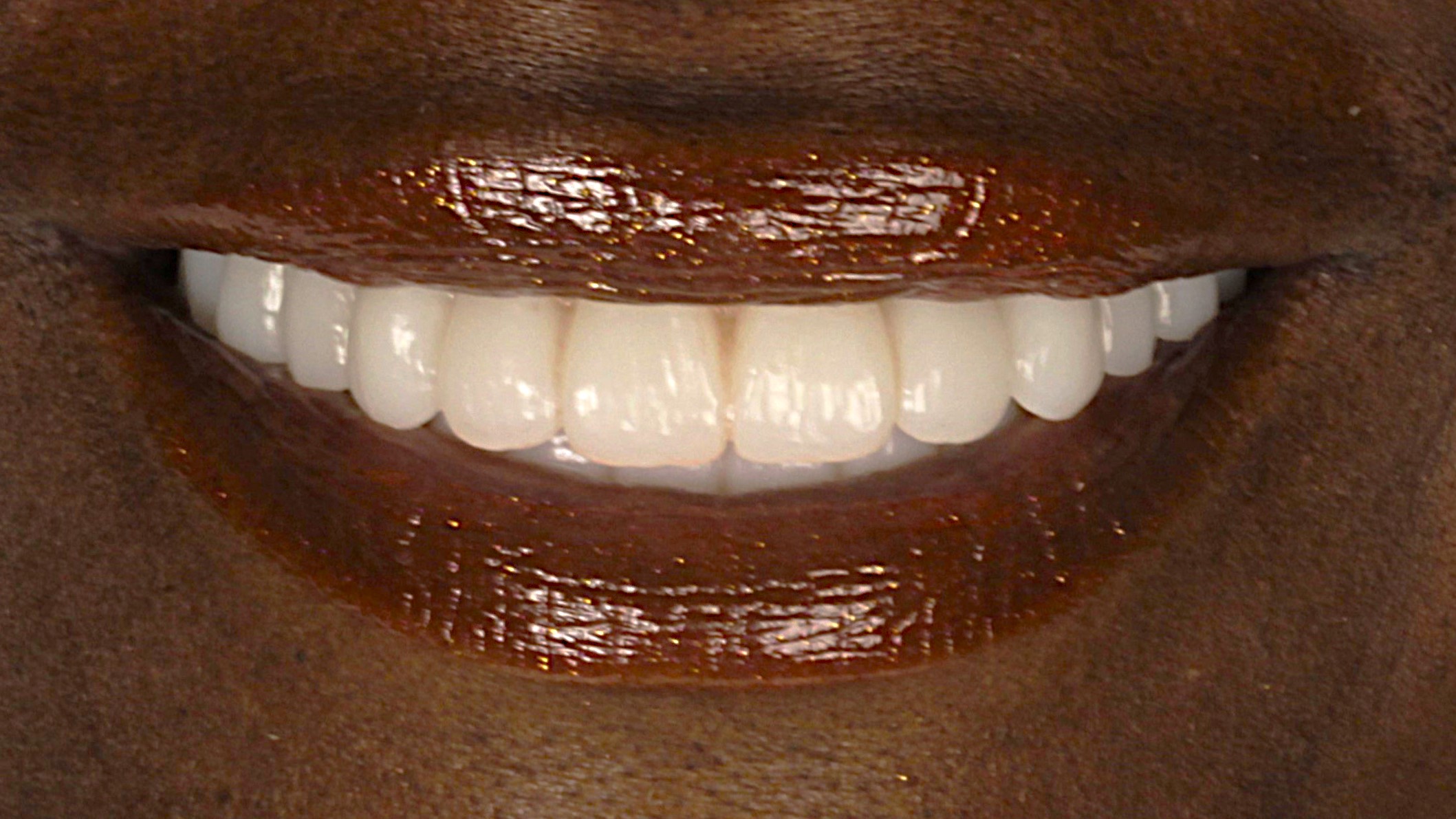 After: double arch case 30