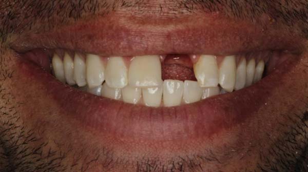 Before: full mouth reconstruction case 12