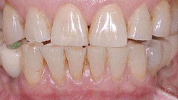 Before: smile makeover case 16