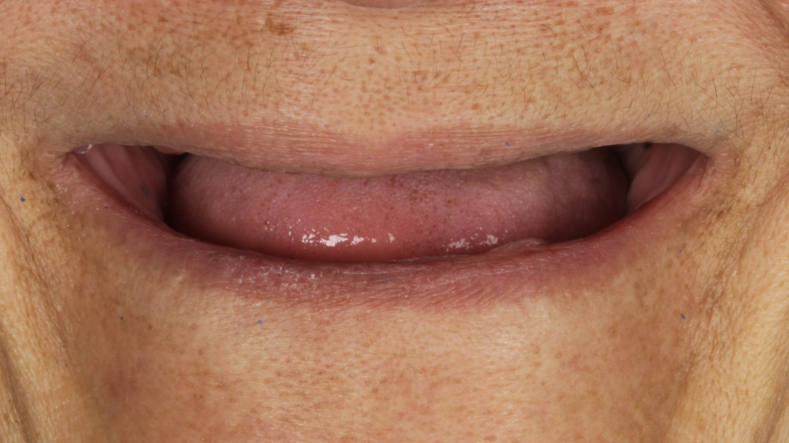 Before: double arch case 33