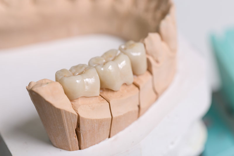A three-unit ceramic bridge on a stone model