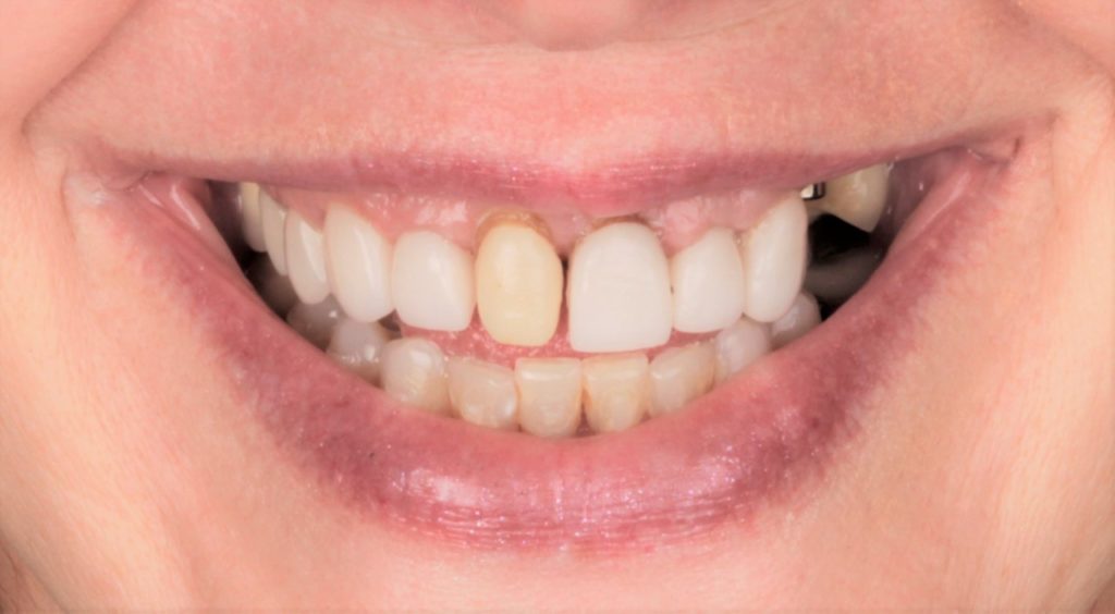 Before: full mouth reconstruction case 4