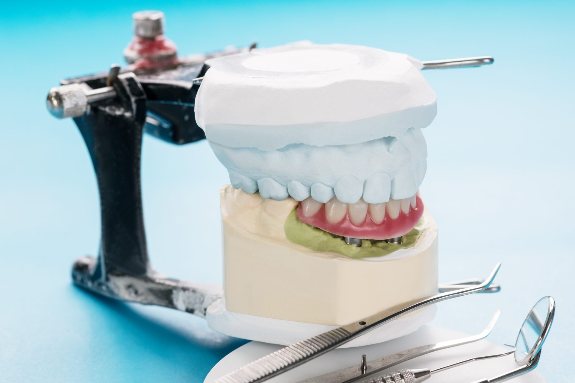 Lab model of an implant-supported denture clipped onto implant posts, mounted on an articulator