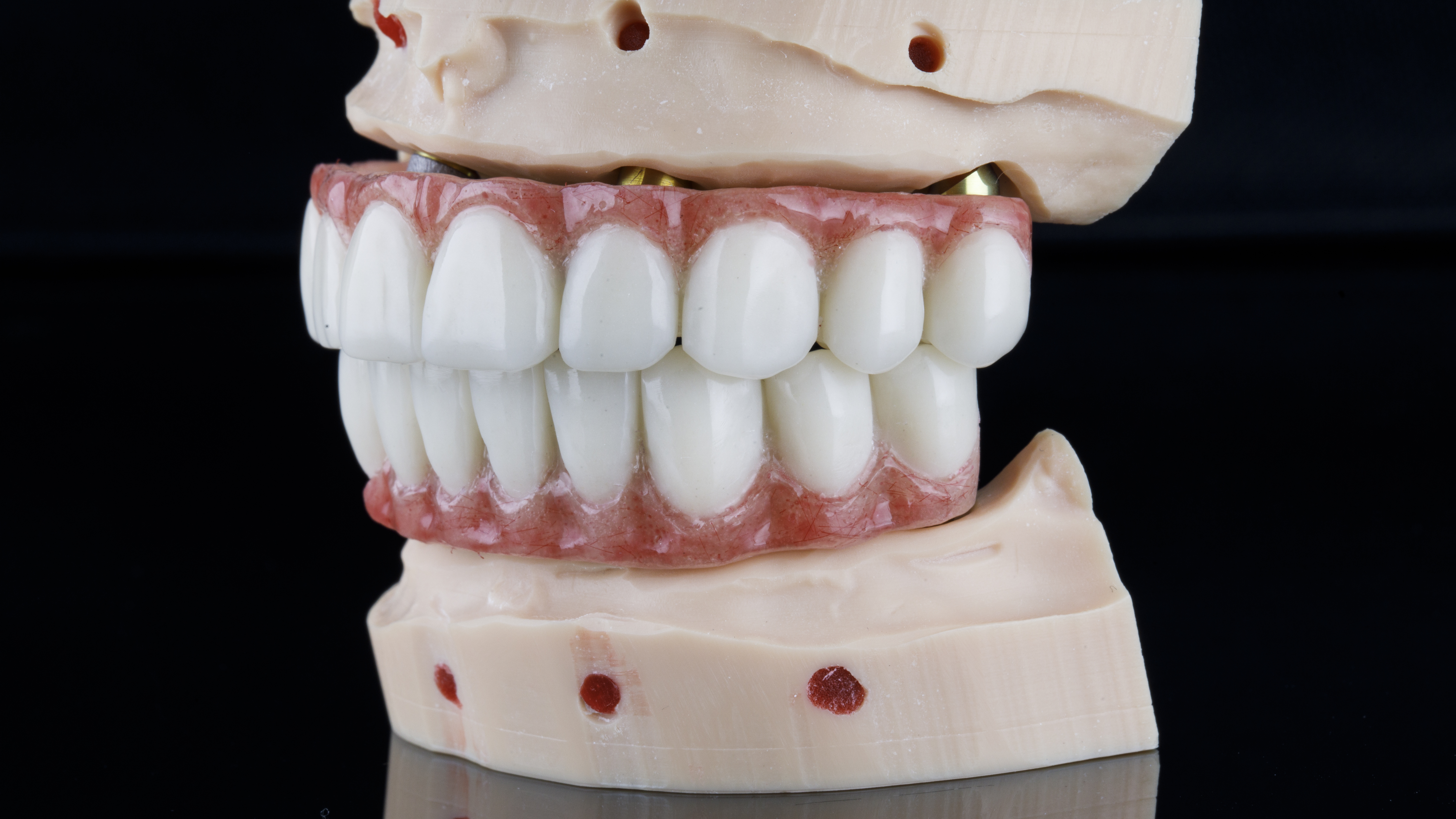 Dental prostheses for the lower and upper scab of the patient on the model