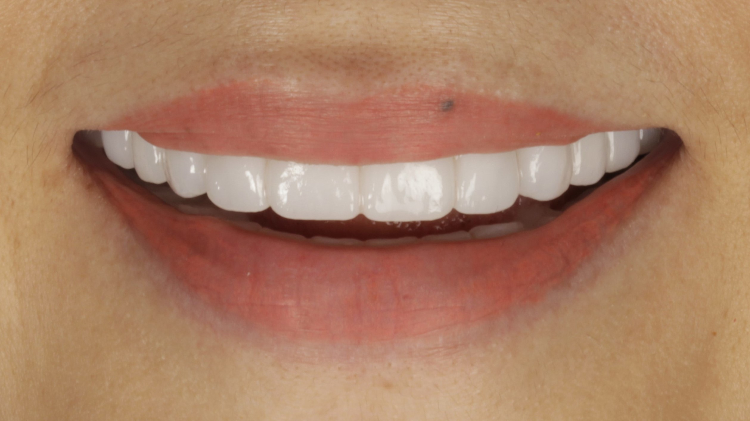 After: double arch case 32