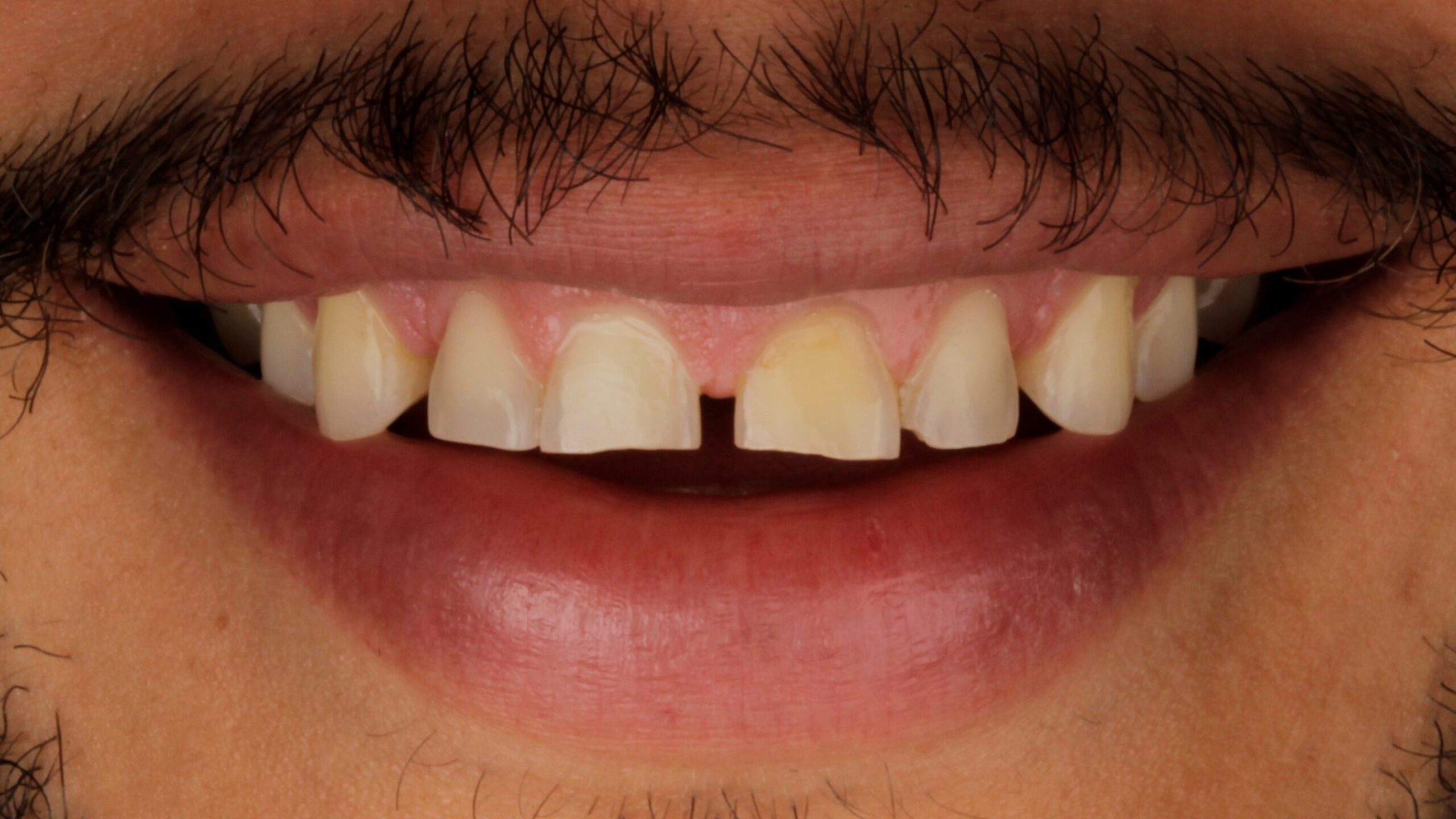 Before: porcelain veneers case 35