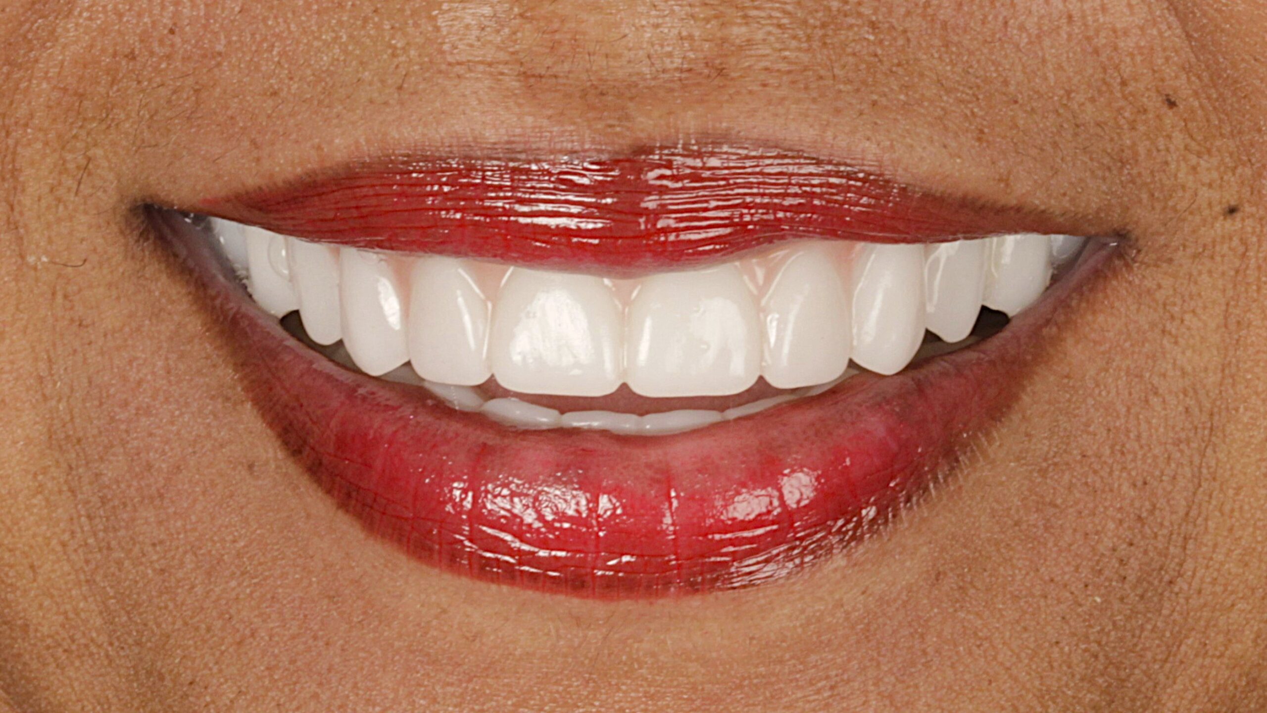 After: double arch case 26