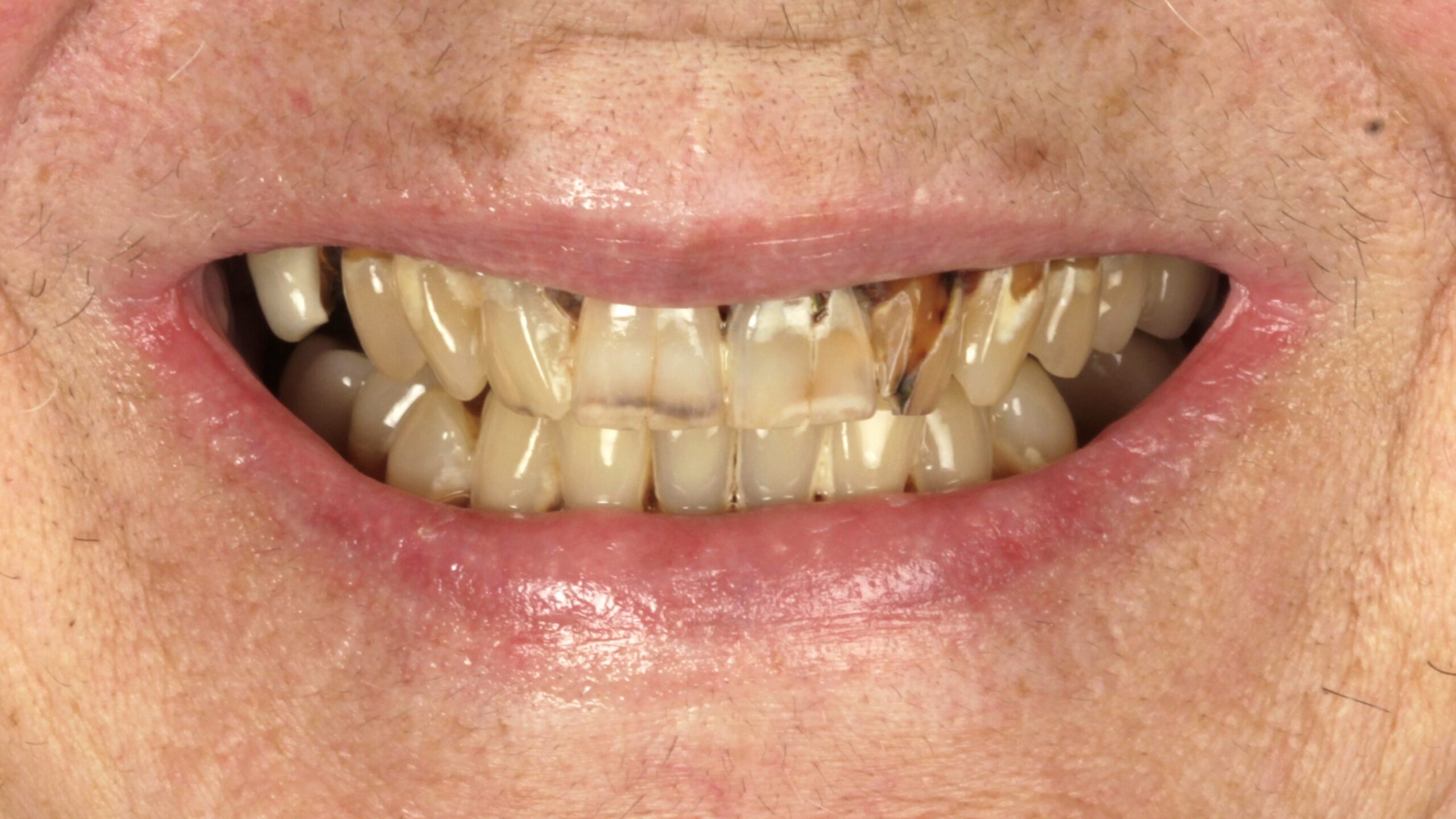 Before: double arch case 24