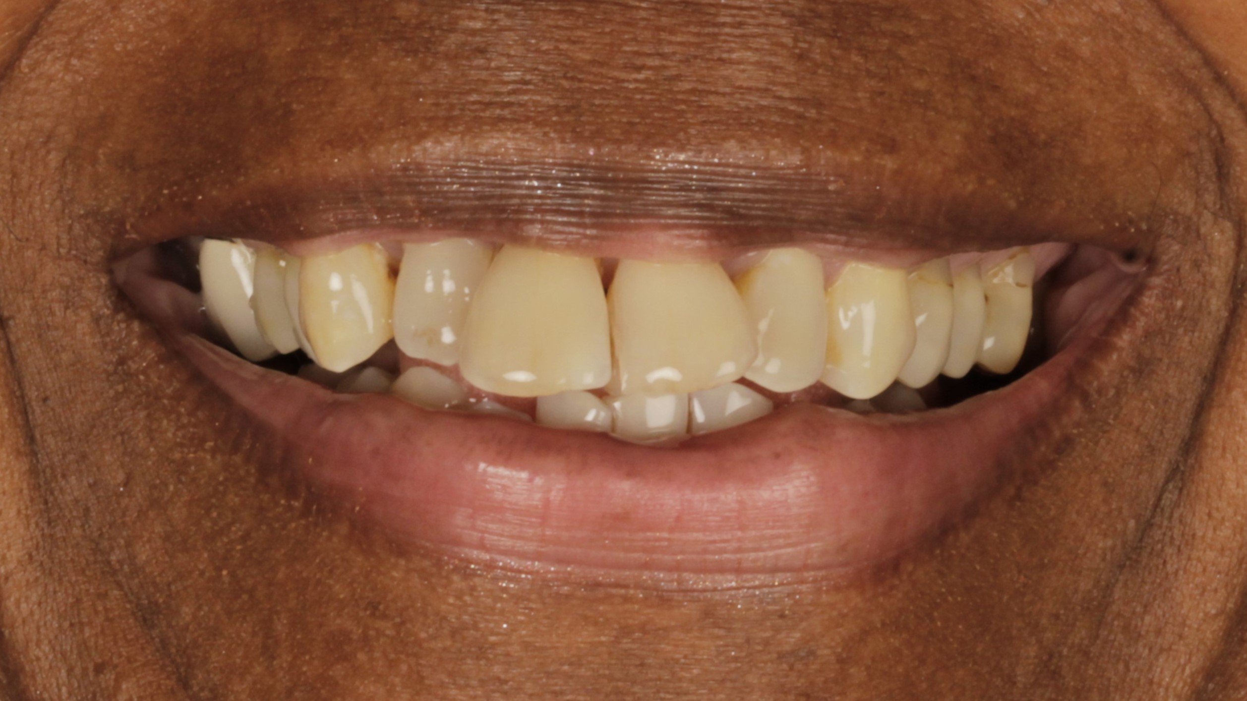 Before: damaged and missing teeth