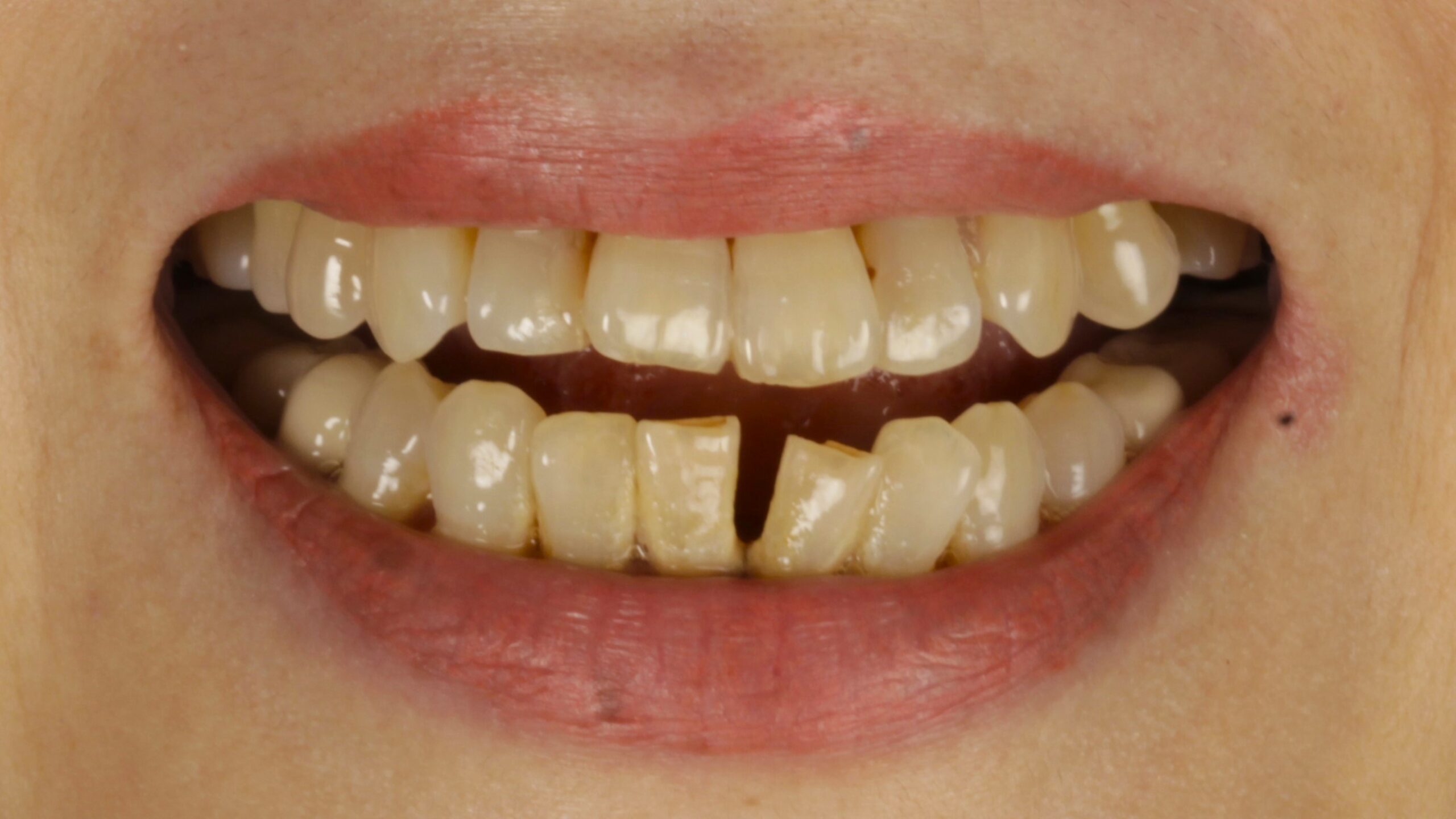 Before: double arch case 32