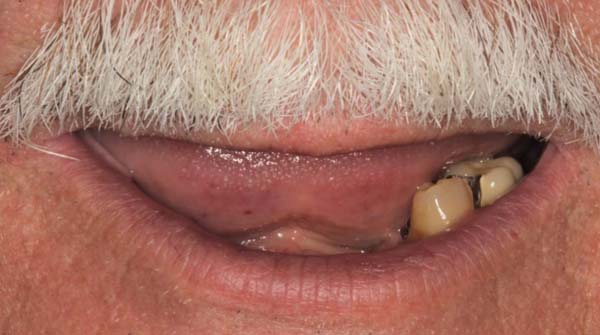 Before: full mouth reconstruction case 8