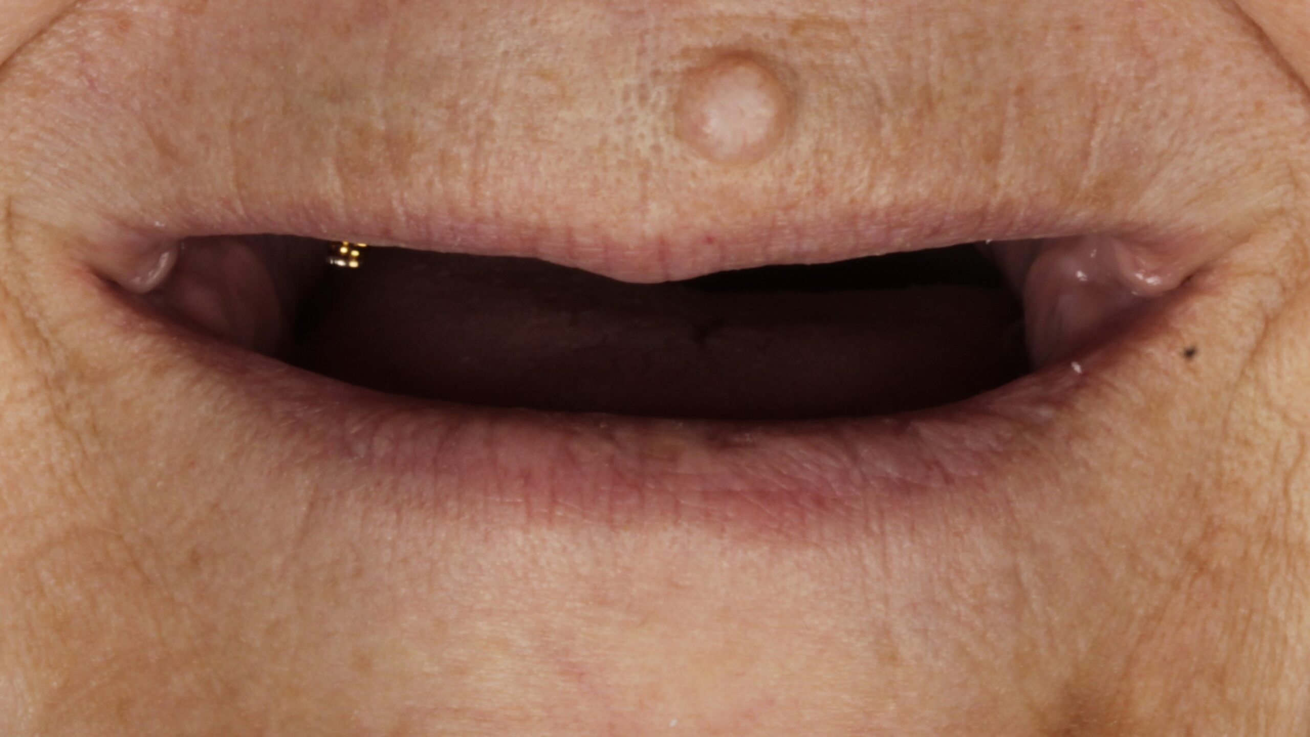 Before: double arch case 29