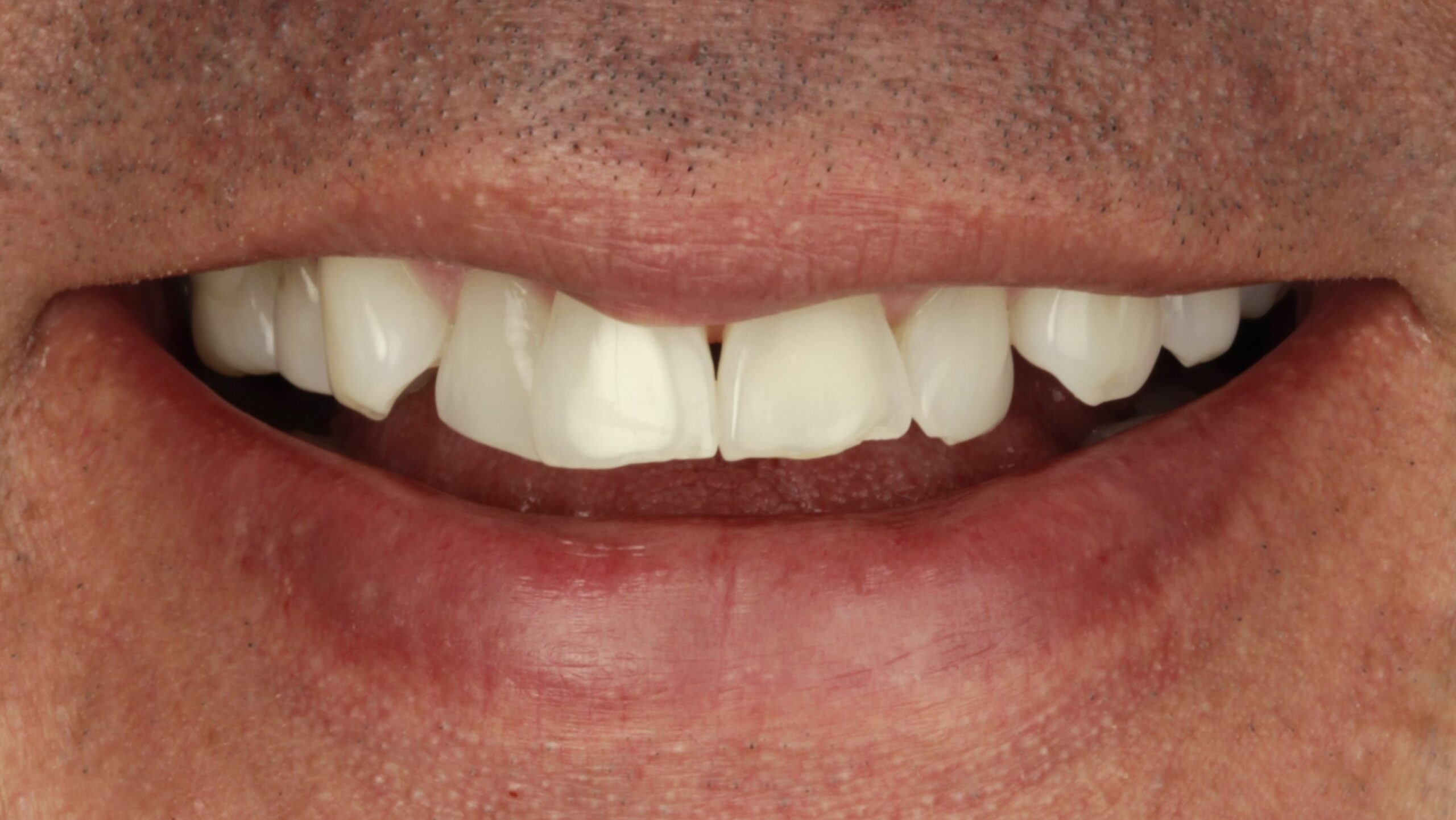 Before: porcelain veneers case 37