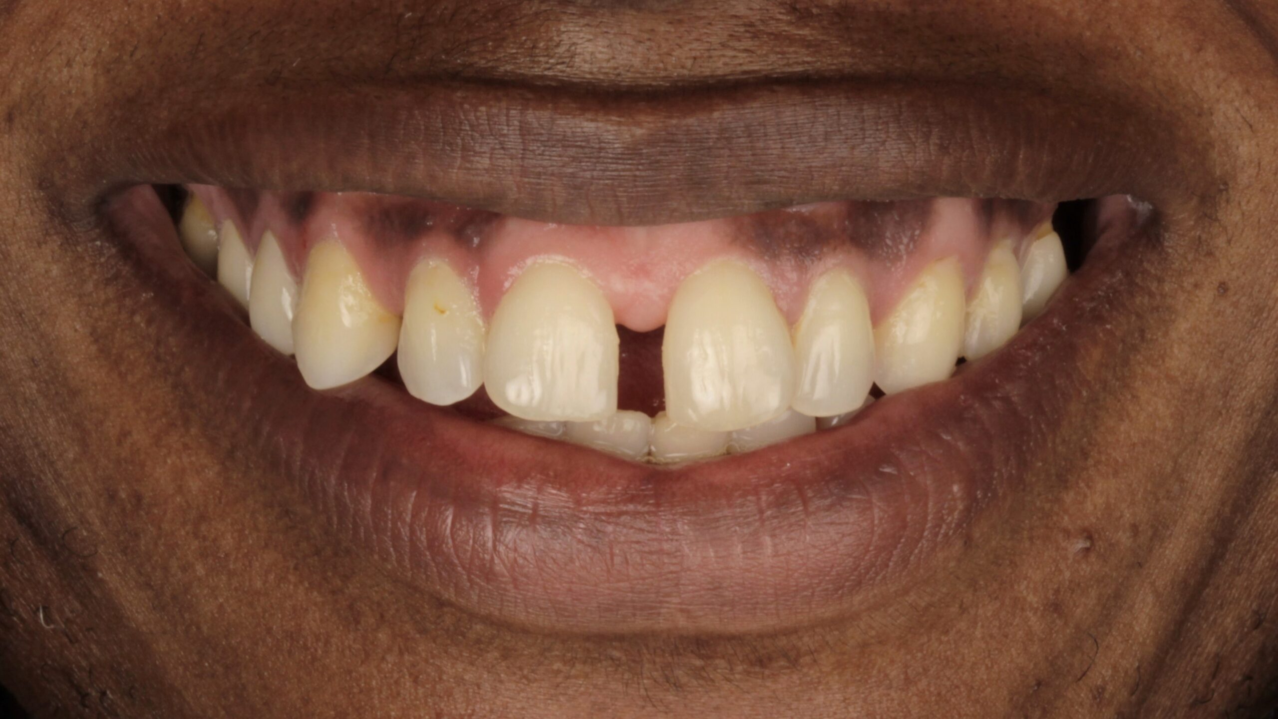 Before: porcelain veneers case 38